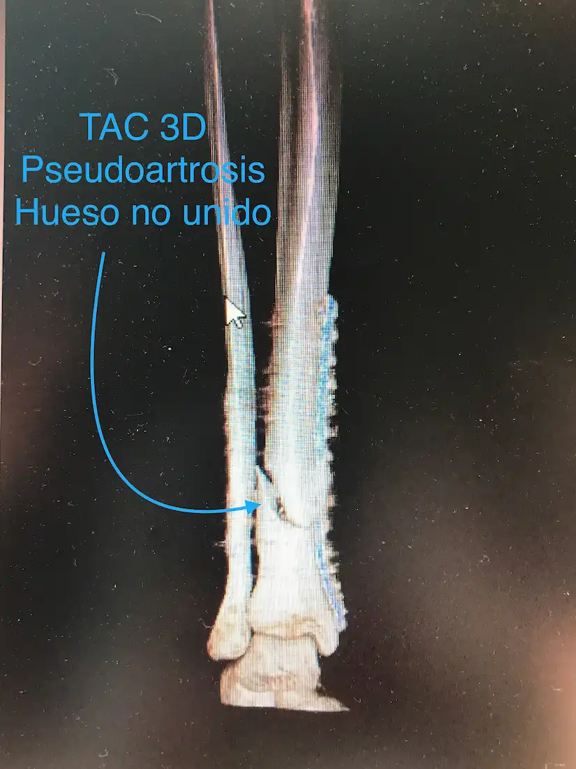 PSEUDOARTROSIS DE TIBIA