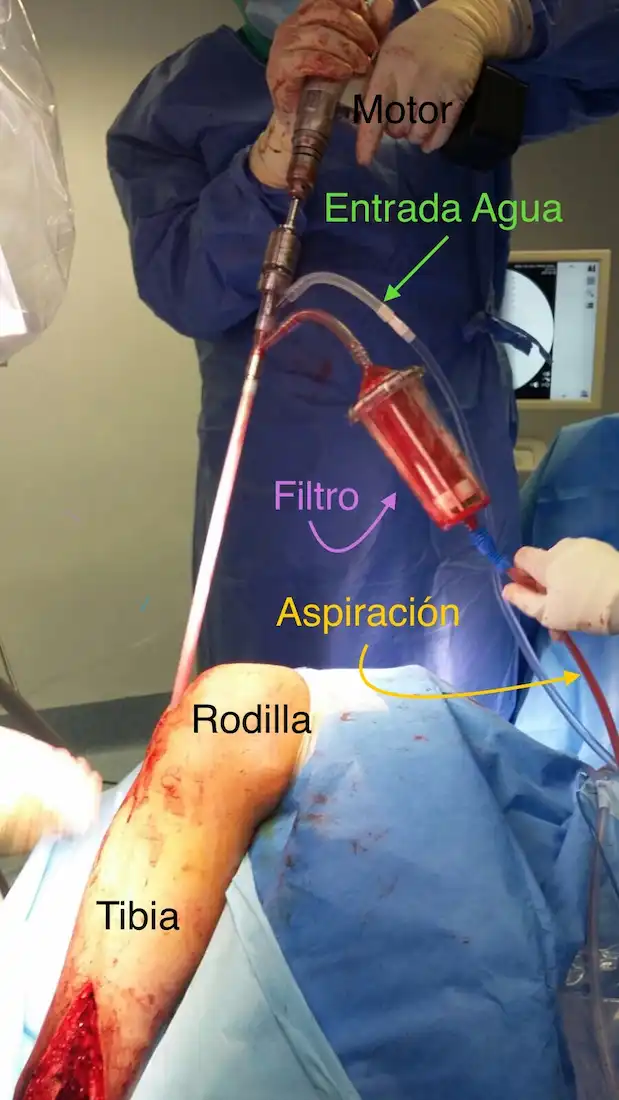 PSEUDOARTROSIS DE TIBIA