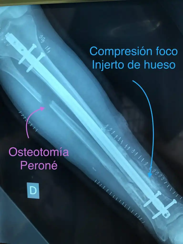 PSEUDOARTROSIS DE TIBIA