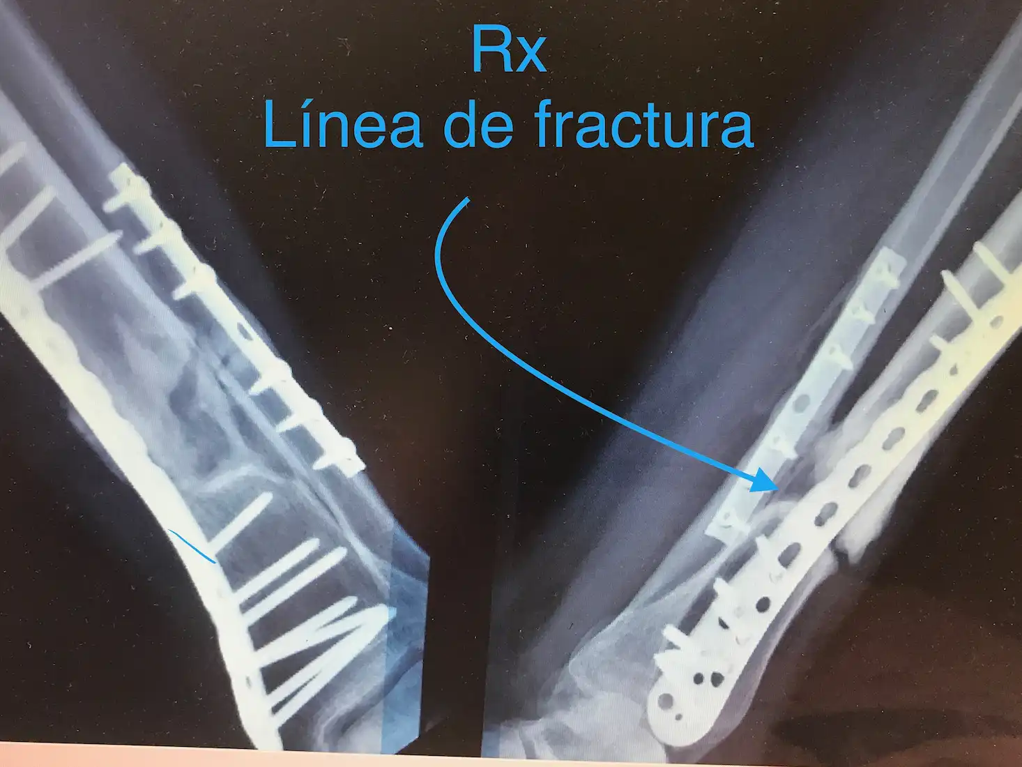 PSEUDOARTROSIS DE TIBIA