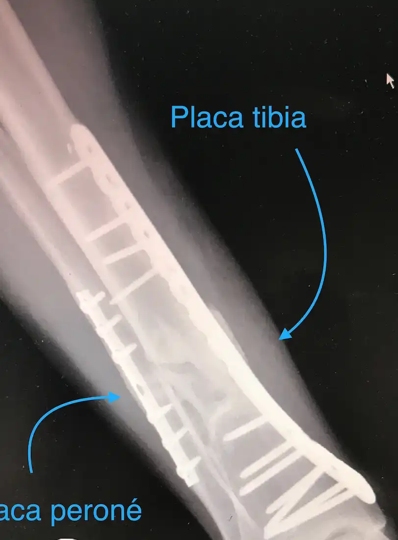 PSEUDOARTROSIS DE TIBIA