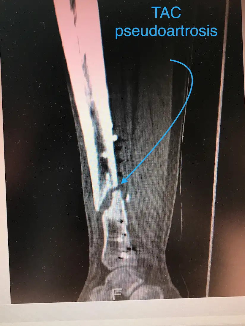 PSEUDOARTROSIS DE TIBIA