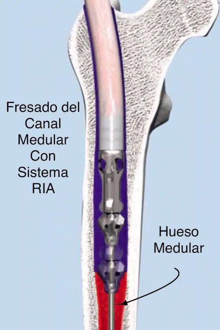 PSEUDOARTROSIS DE TIBIA