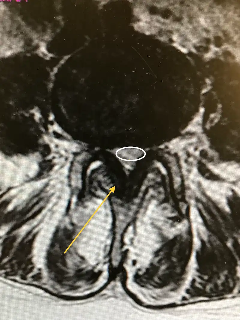 Estenosis de Canal Lumbar