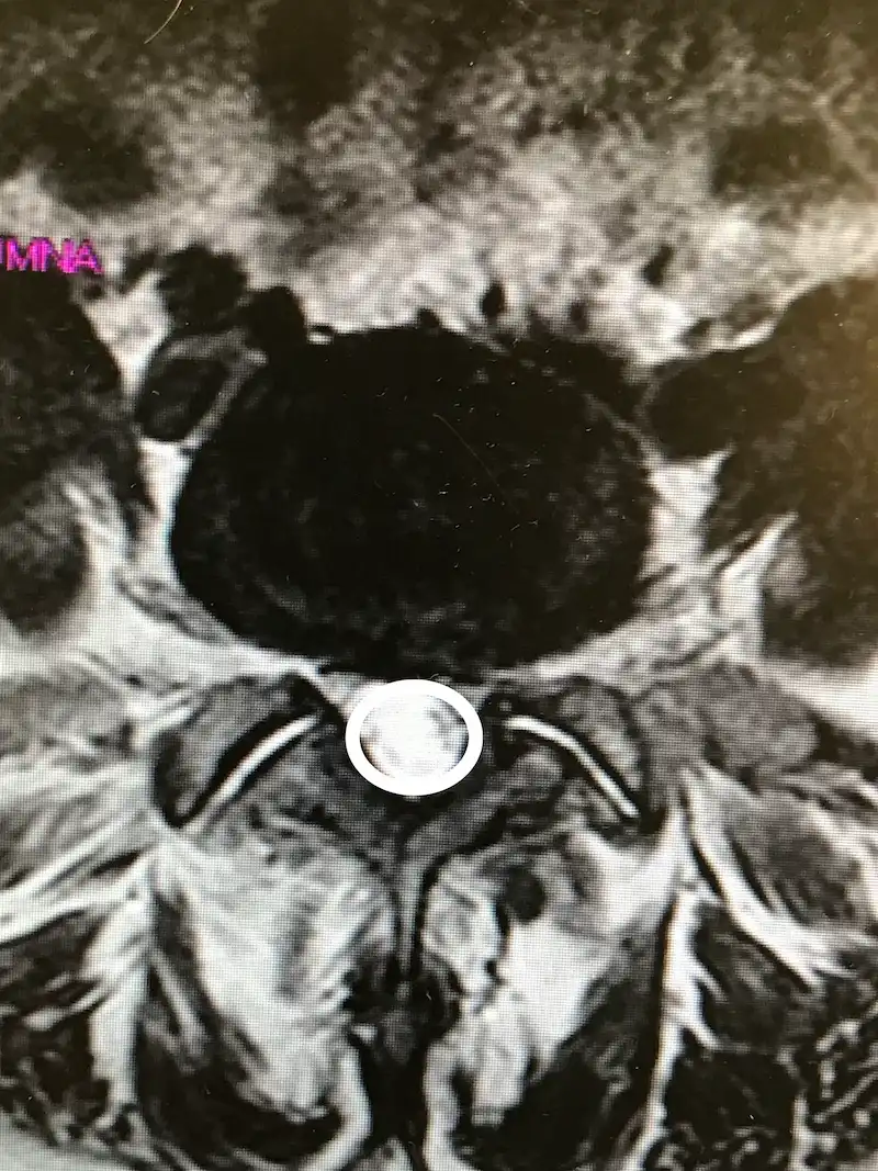 Estenosis de Canal Lumbar