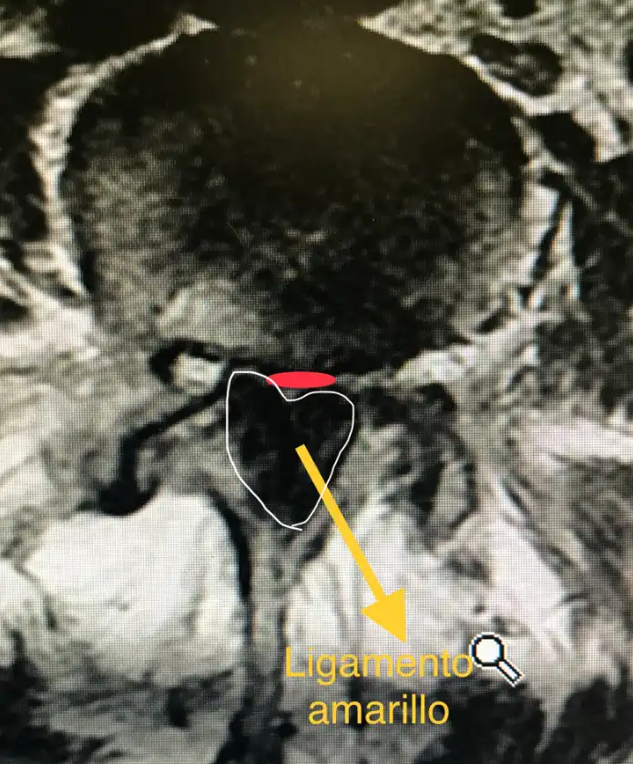 Estenosis de Canal Lumbar