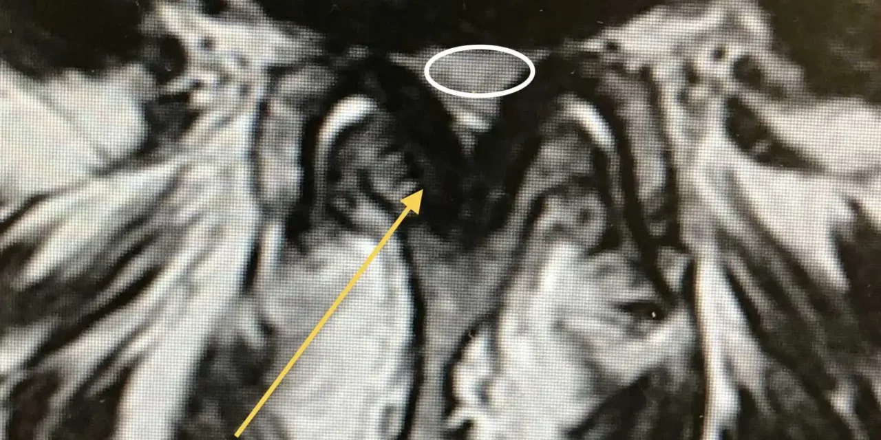 Estenosis de Canal Lumbar por Hipertrofia de Ligamento Amarillo