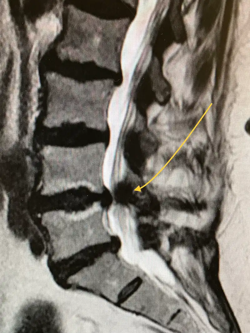 Estenosis de Canal Lumbar