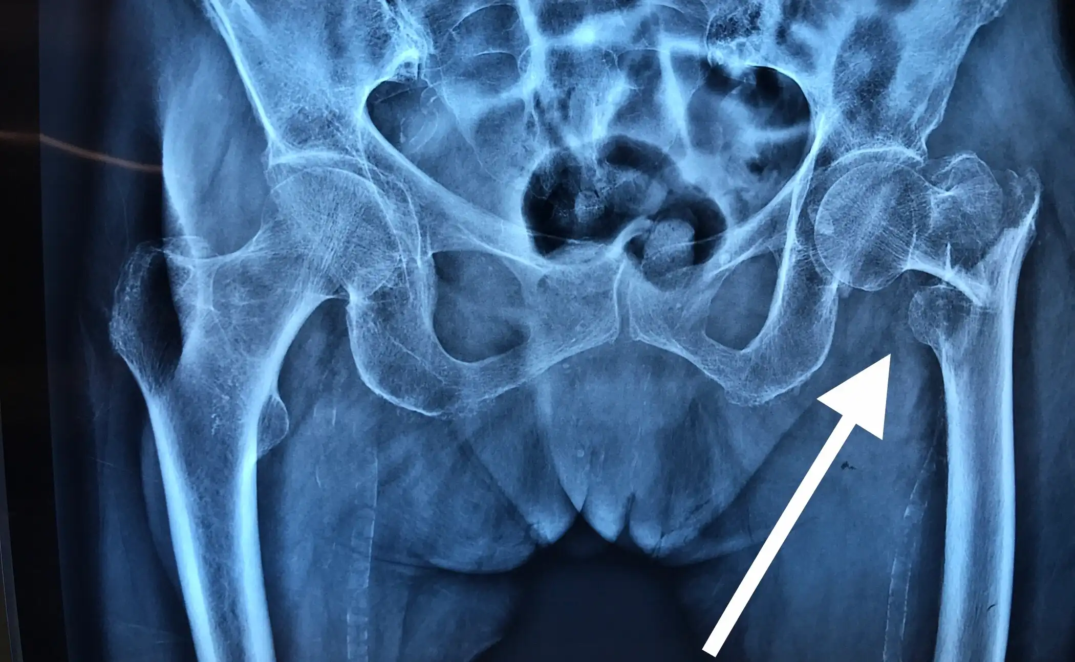 Fractura de cadera izquierda