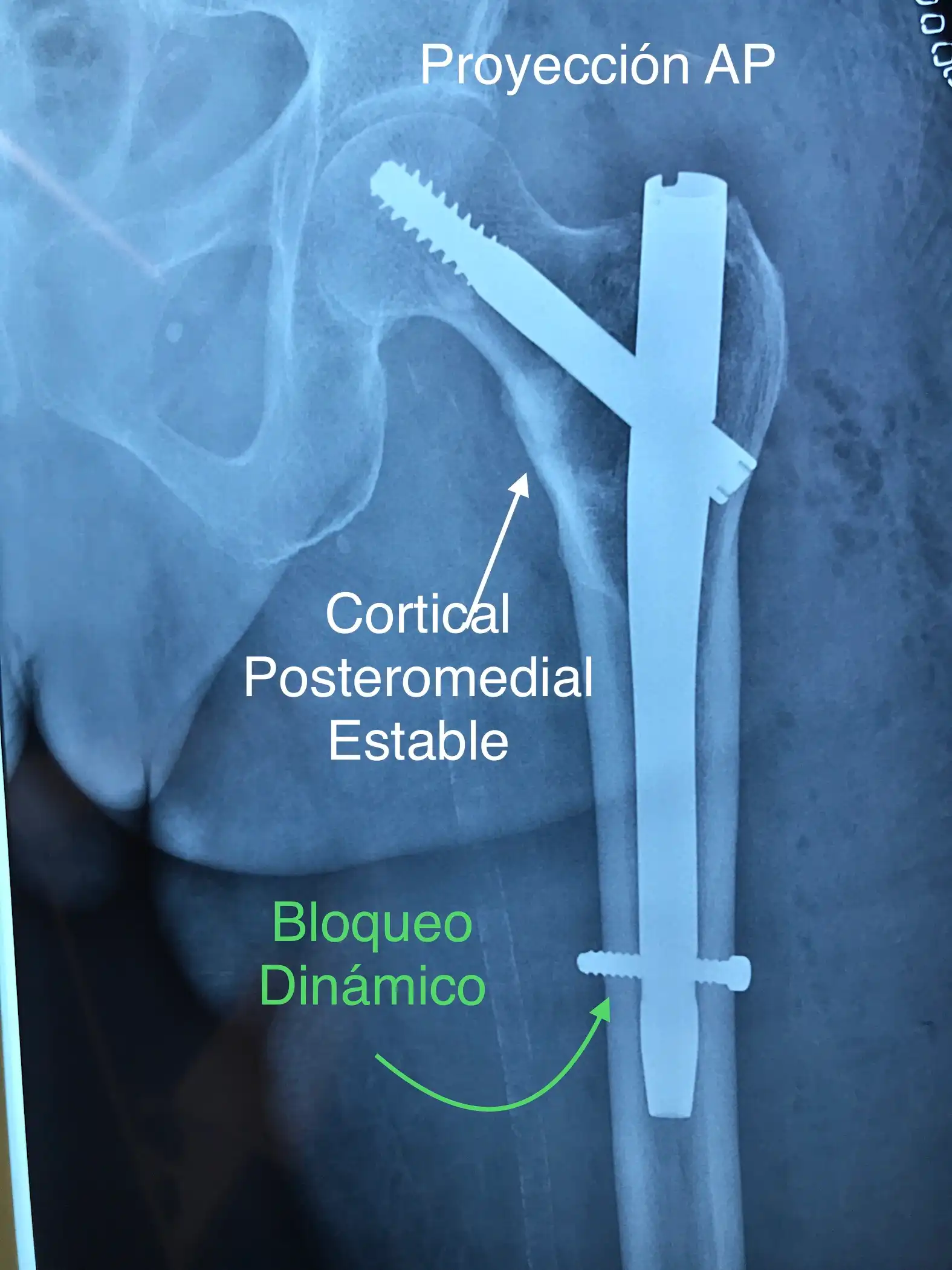 Fractura de cadera y clavo