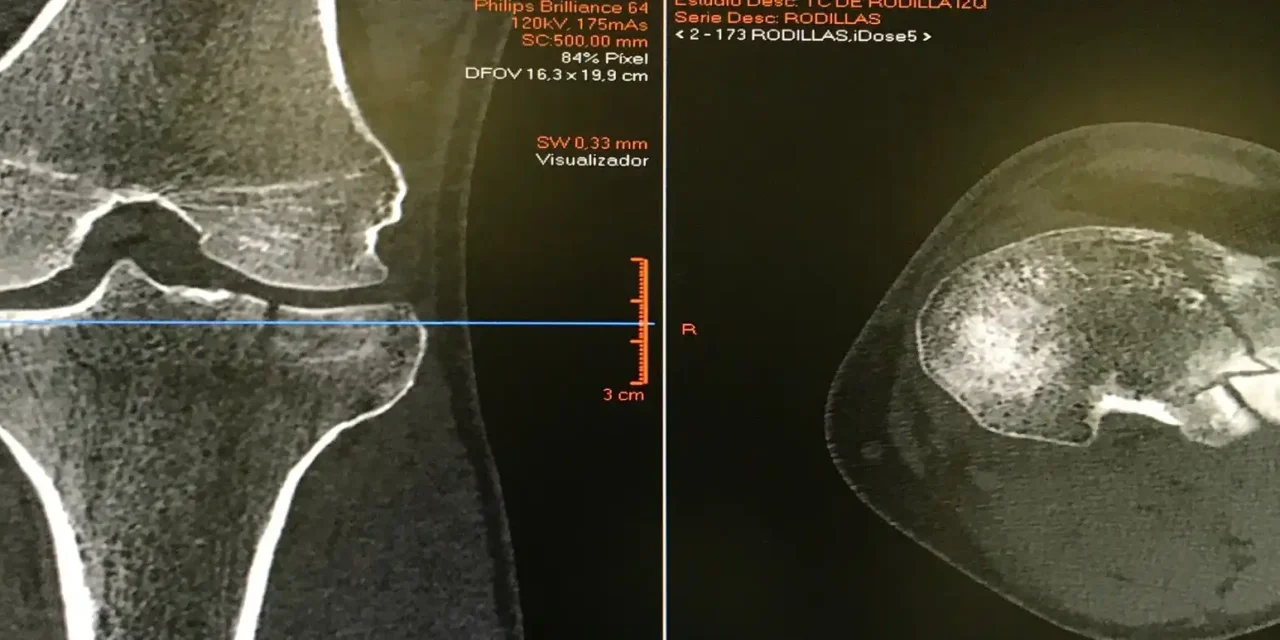 FRACTURA DE MESETA TIBIAL