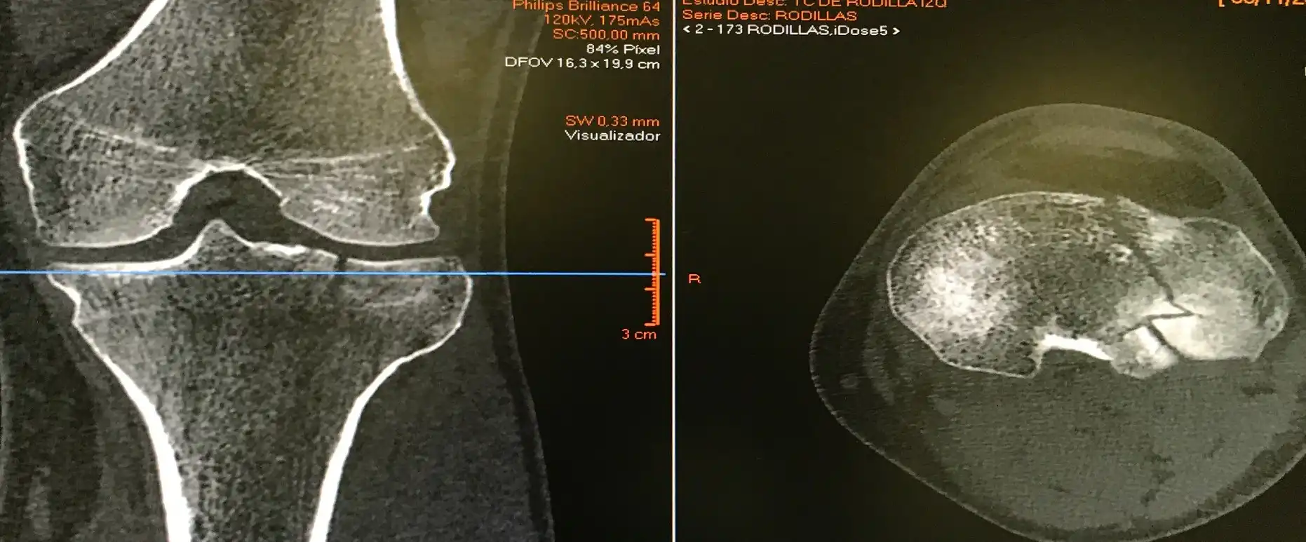 FRACTURA DE MESETA TIBIAL